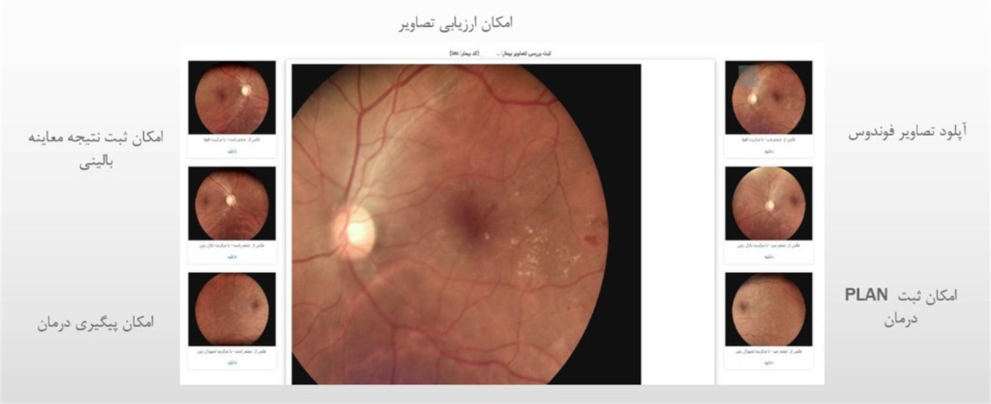 سامانه غربالگری رتینوپاتی دیابتی